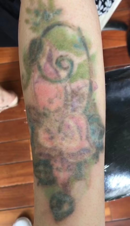 2026年3月云南調(diào)Q激光洗紋身診所最新推薦，調(diào)Q技術(shù)溫和修